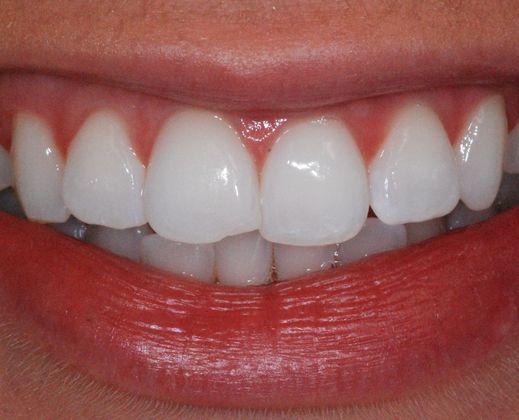 Dental Veneers Case 4 - Before