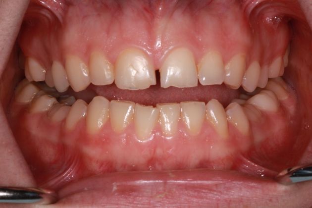 Dental Veneers Case 5 - Before