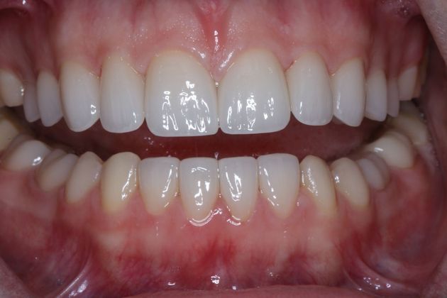 Dental Veneers Case 5 - After