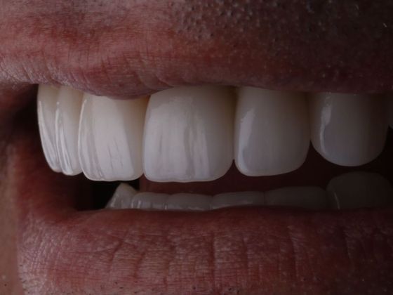 Dental Veneers: Case 6 - After