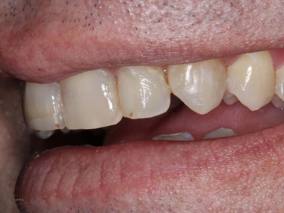 Dental Veneers: Case 6 - Before