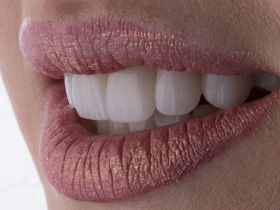 Dental Veneers Case 7 - After