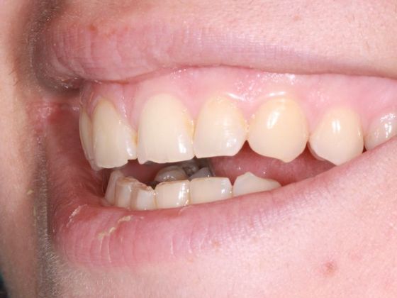 Dental Veneers Case 7 - Before