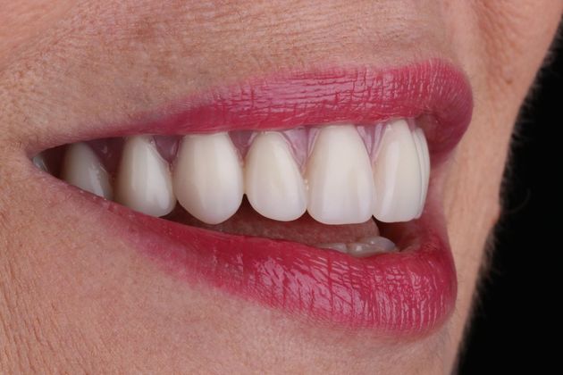 Dentures Case 4 - After