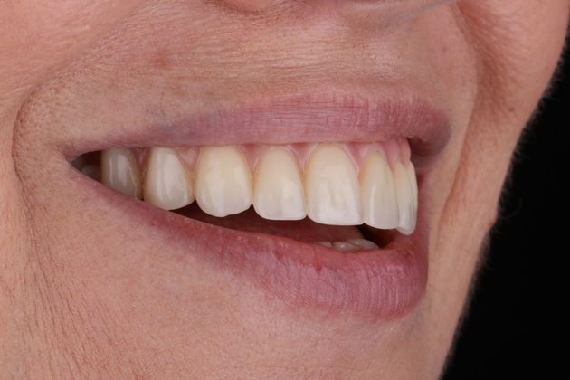 Dentures Case 4 - Before