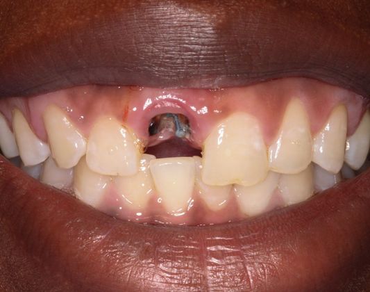 Dental Implants: Case 4 - Before