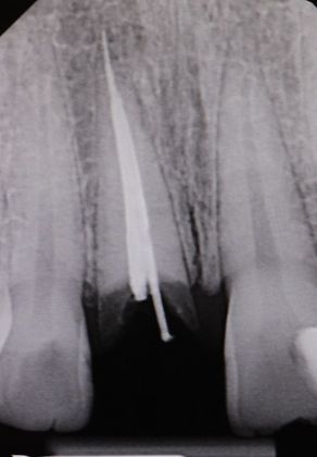 Dental Implants: Case 4 - Before