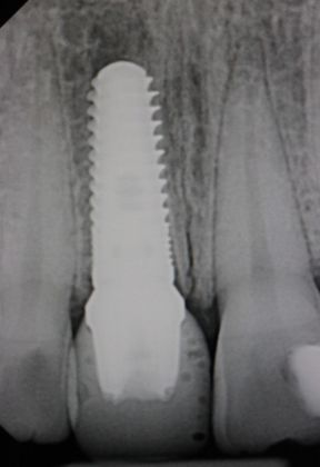 Dental Implants: Case 4 - After