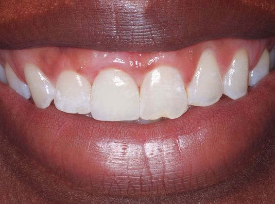Dental Implants: Case 4 - After