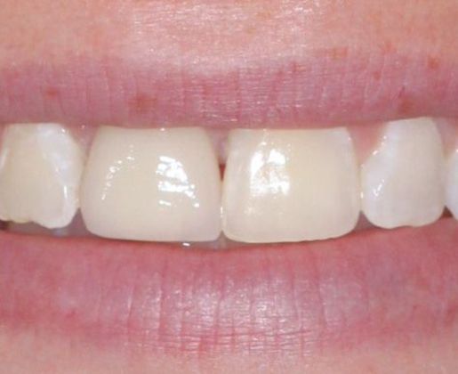 Dental Implants Case 3 - After