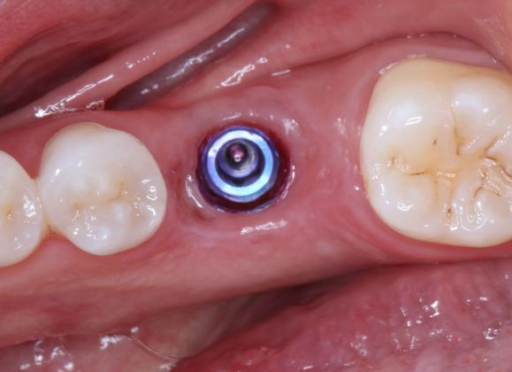 Dental Implants: Case 5 - Before