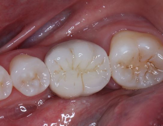 Dental Implants: Case 5 - After