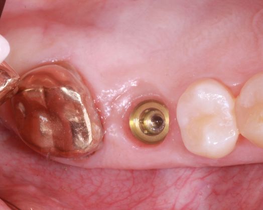 Dental Implants: Case 6 - Before