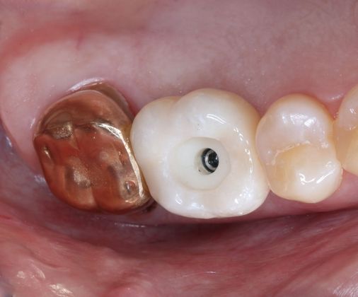 Dental Implants: Case 6 - Implant crown