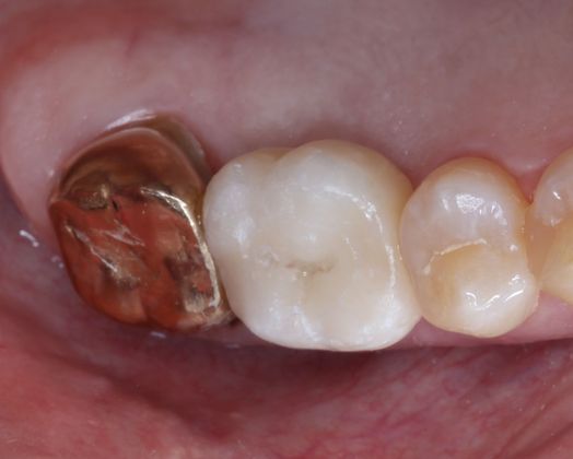 Dental Implants: Case 6 - After