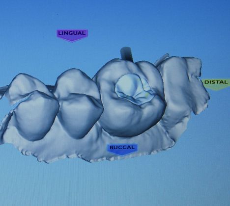 Dental Implants: Case 6 - Digital Plan of the onlay
