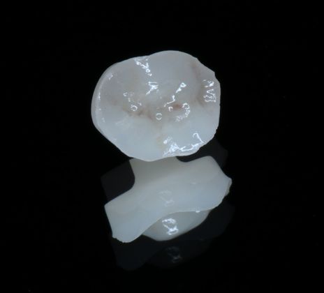 Dental Implants: Case 6 - Onlay to cover the hole