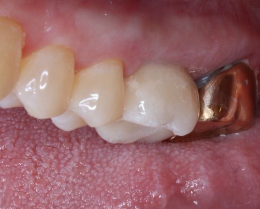 Dental Implants: Case 6 - Final