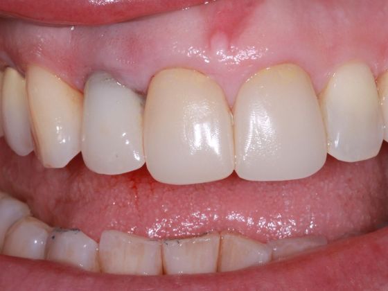 Dental Implants: Case 7 - Before