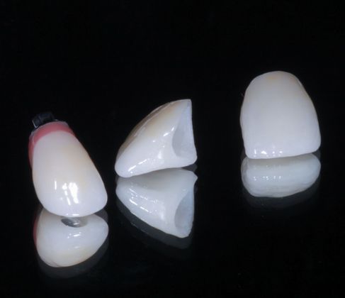 Dental Implants: Case 7 - Implant crown and crowns