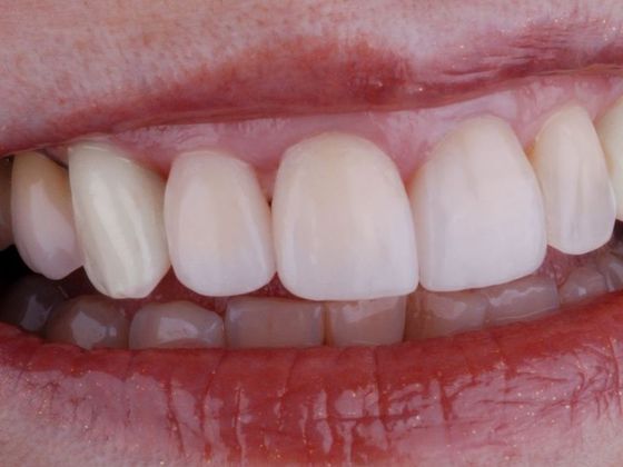 Dental Implants: Case 7 - After