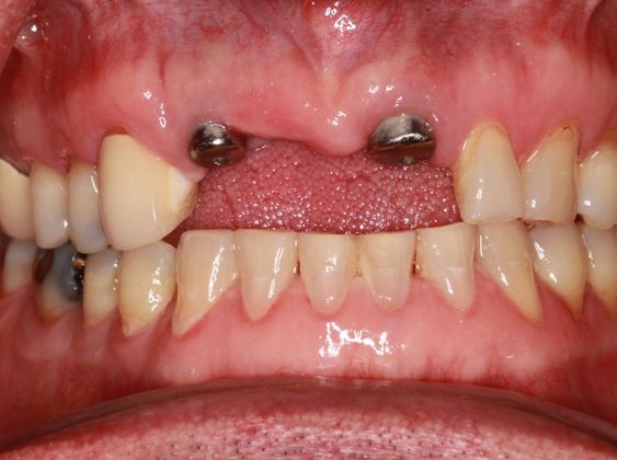Dental Implants: Case 8 - Before
