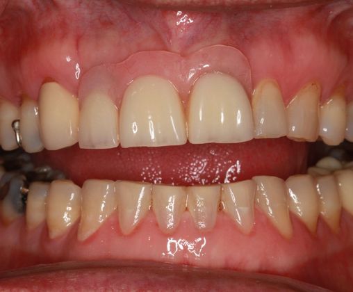 Dental Implants: Case 8 - Before