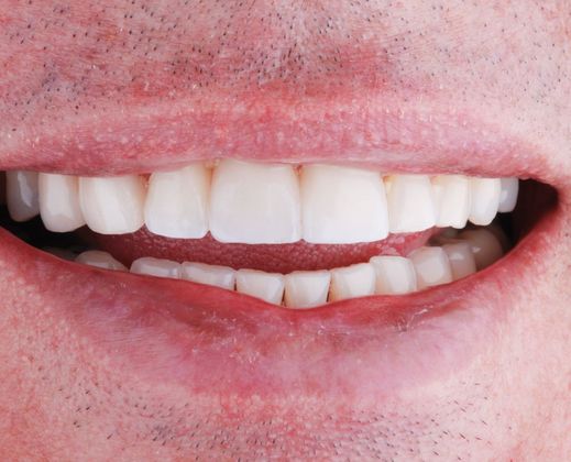 Dental Implants: Case 8 - After