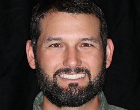 Trial Smiles Case 2 - After