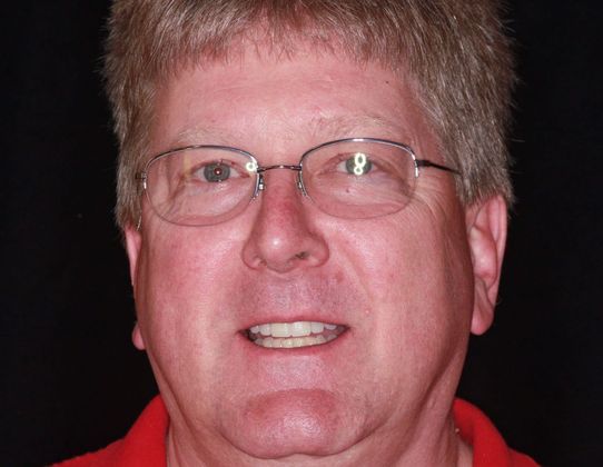 Trial Smiles Case 4 - After