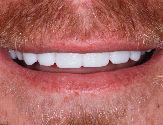 Trial Smiles Case 5 - After