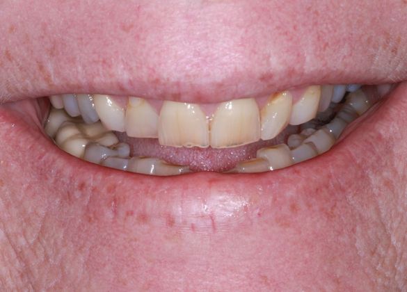 Trial Smiles Case 6 - Before