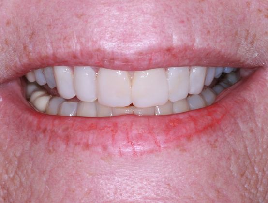 Trial Smiles Case 6 - After