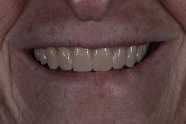 Trial Smiles Case 7 - After