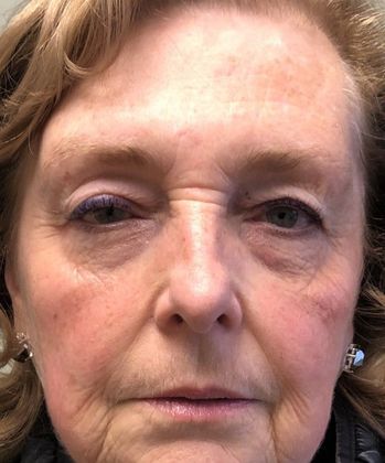 Eyelid Lift: Case 21 Upper Eyelid Lift, Branford, CT - Before
