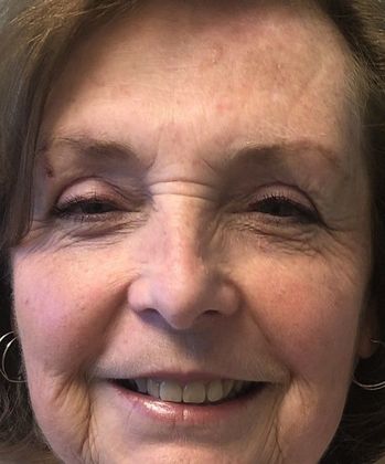 Eyelid Lift: Case 21 Upper Eyelid Lift, Branford, CT - After