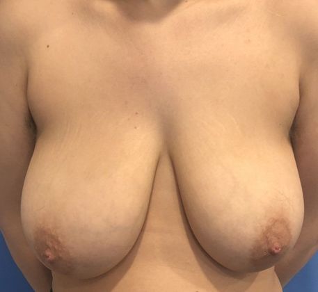 Breast Reduction Case 12 Breast Reduction, Darien - Before