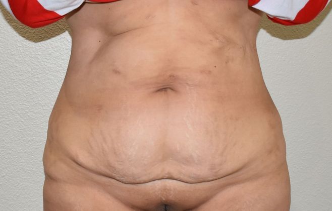 Tummy Tuck (Abdominoplasty): Case 216 - Before