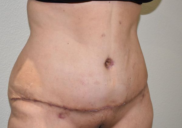 Tummy Tuck (Abdominoplasty): Case 216 - After