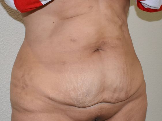 Massive Weight Loss : Case 62 - Before