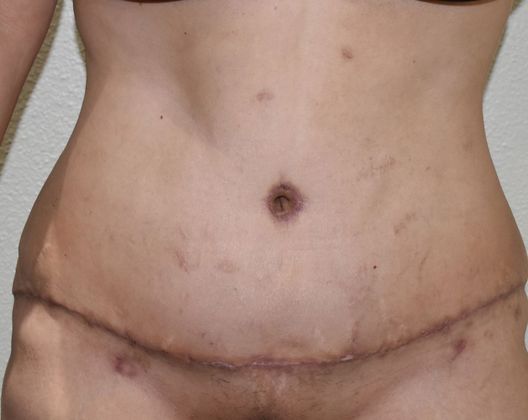 Massive Weight Loss : Case 62 - After
