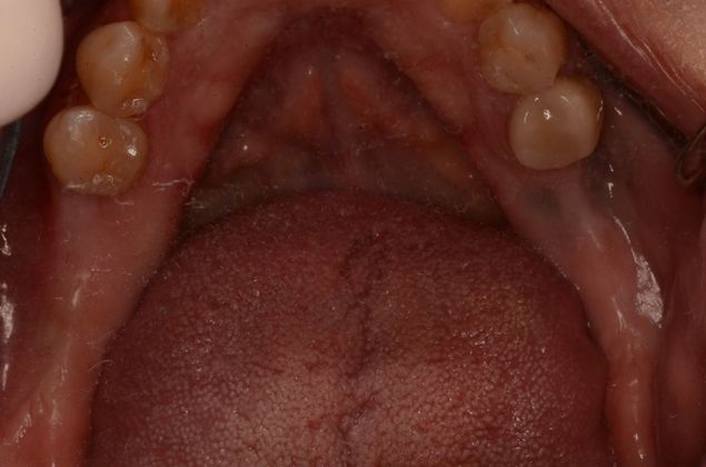 Dental Implants Case 33 - Before