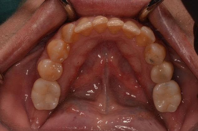 Dental Implants Case 33 - After