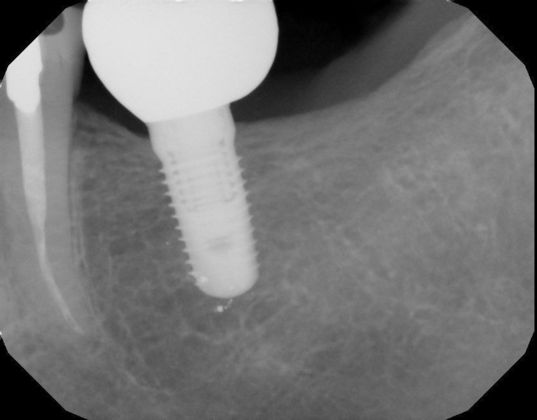 Dental Implants: Case 33 - After