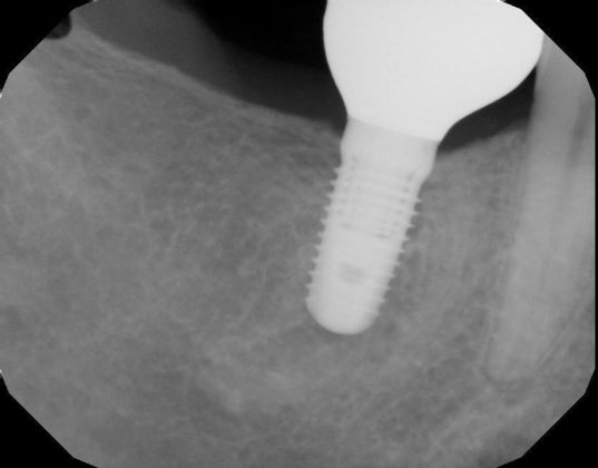 Dental Implants: Case 33 - Before