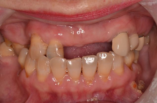 Dental Implants Case 34 - Before