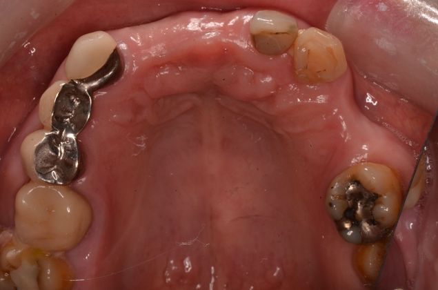 Dental Implants: Case 34 - Before