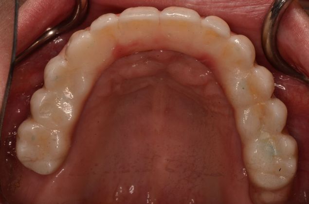 Dental Implants: Case 34 - After
