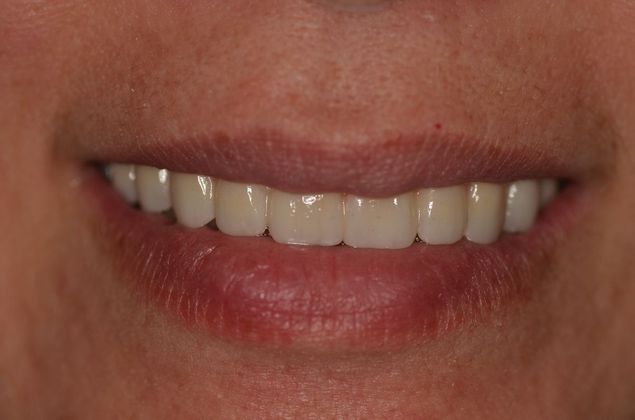Dental Implants Case 34 - After