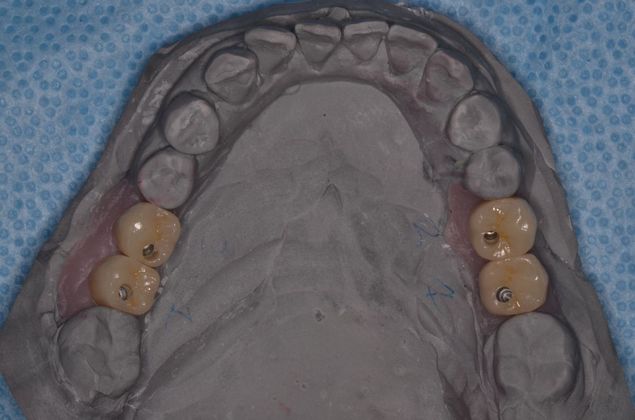 Dental Implants: Case 34 - After